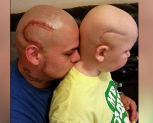 Un padre si è fatto tatuare in testa il segno della cicatrice del figlio Gabriel, operato per un tumore al cervello