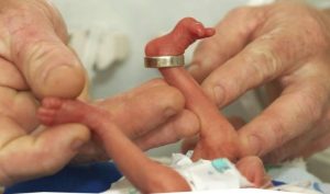 Pesava alla nascita solo 370 grammi, Lorenzo sopravvive grazie ad un intervento chirurgico